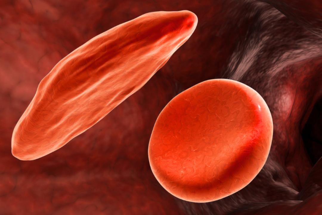 Sickle cell