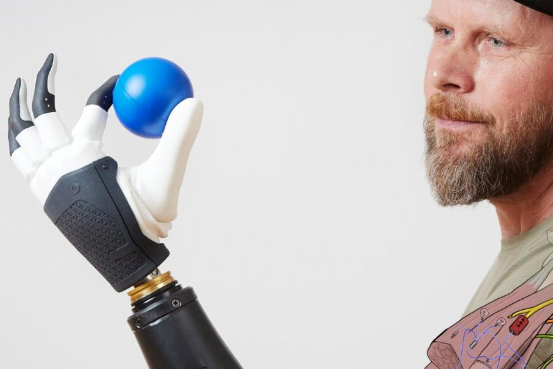 Eric E prosthetic